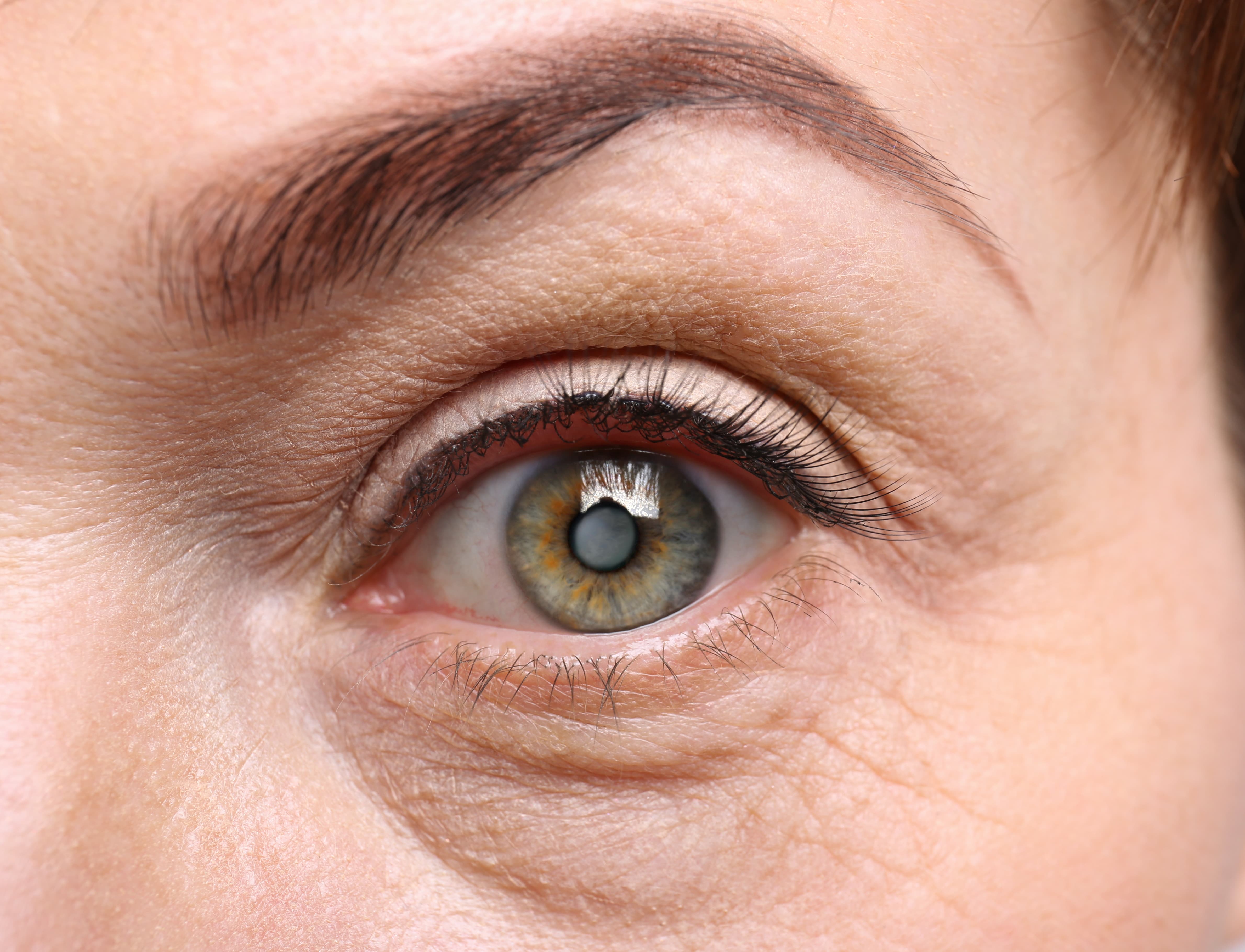 What are the symptoms of cataracts?