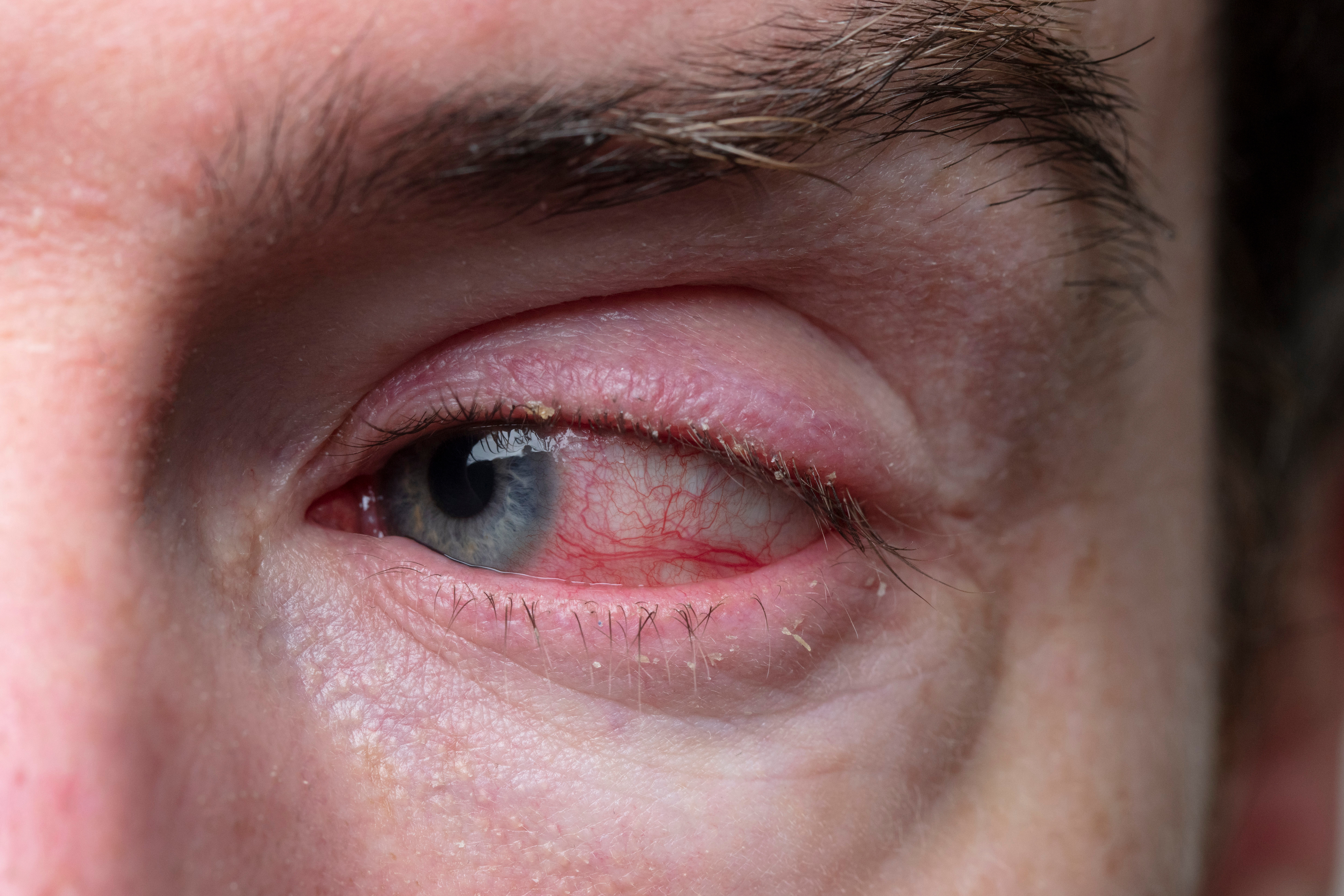 Blepharitis