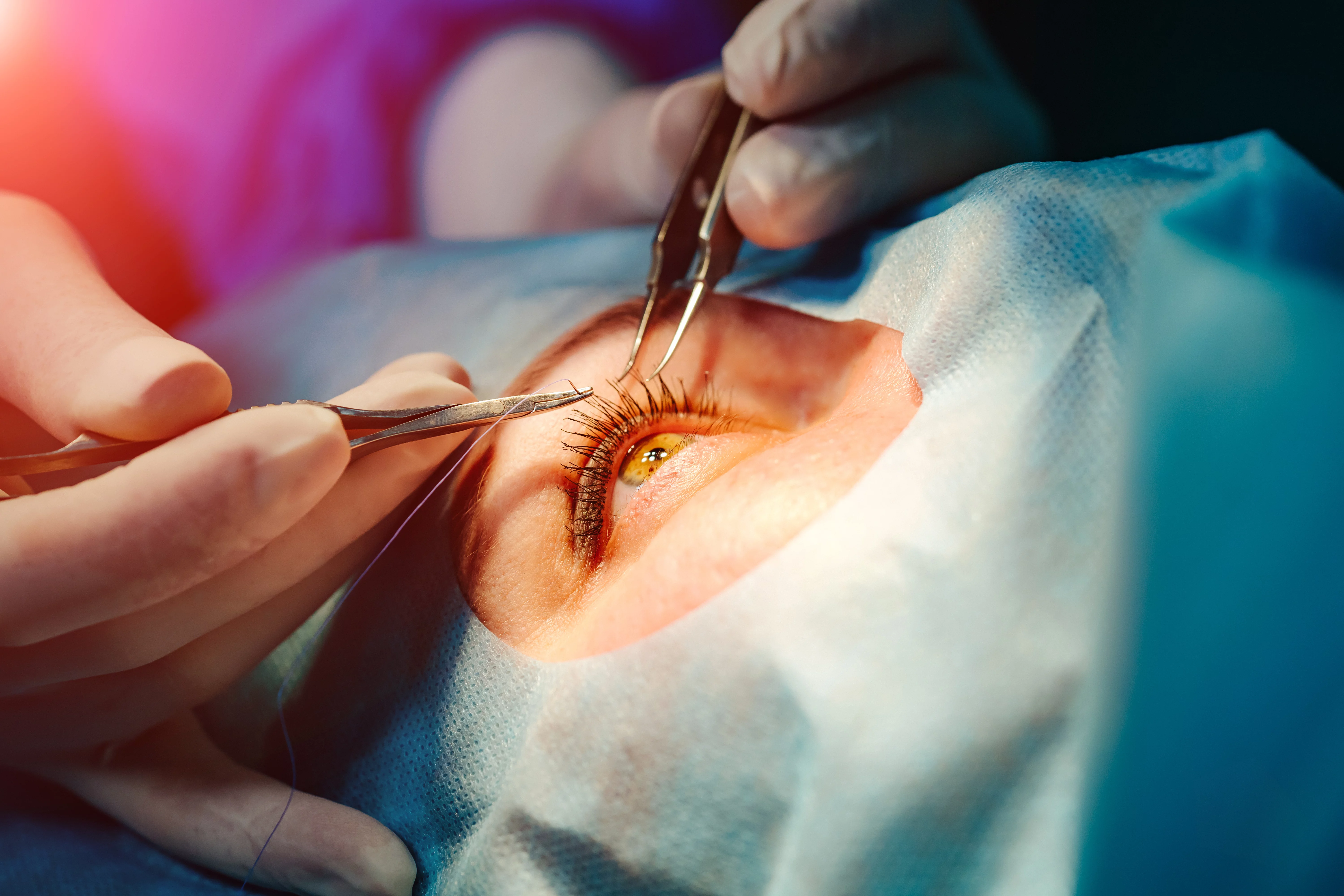 Cataract