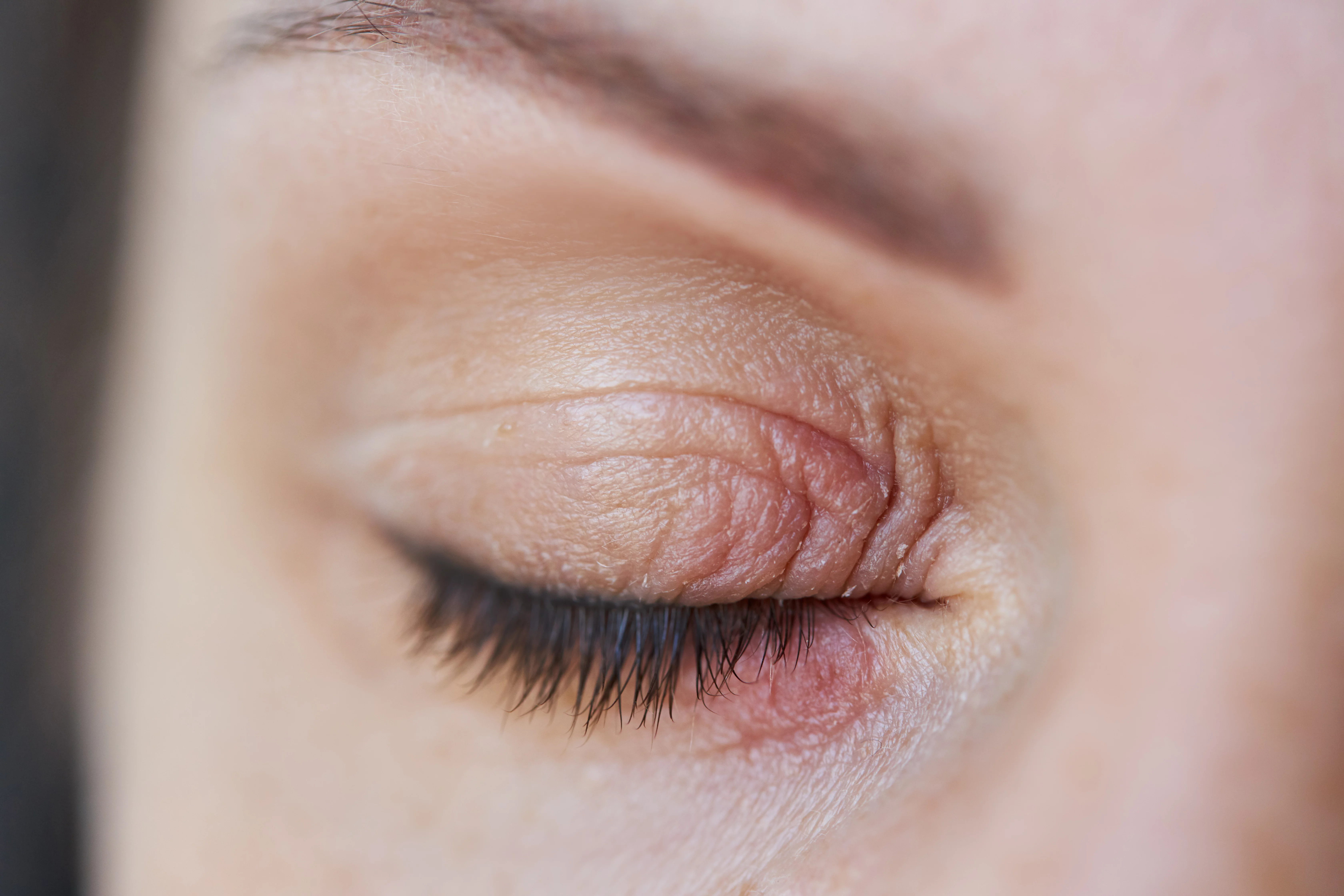 Eyelid allergies