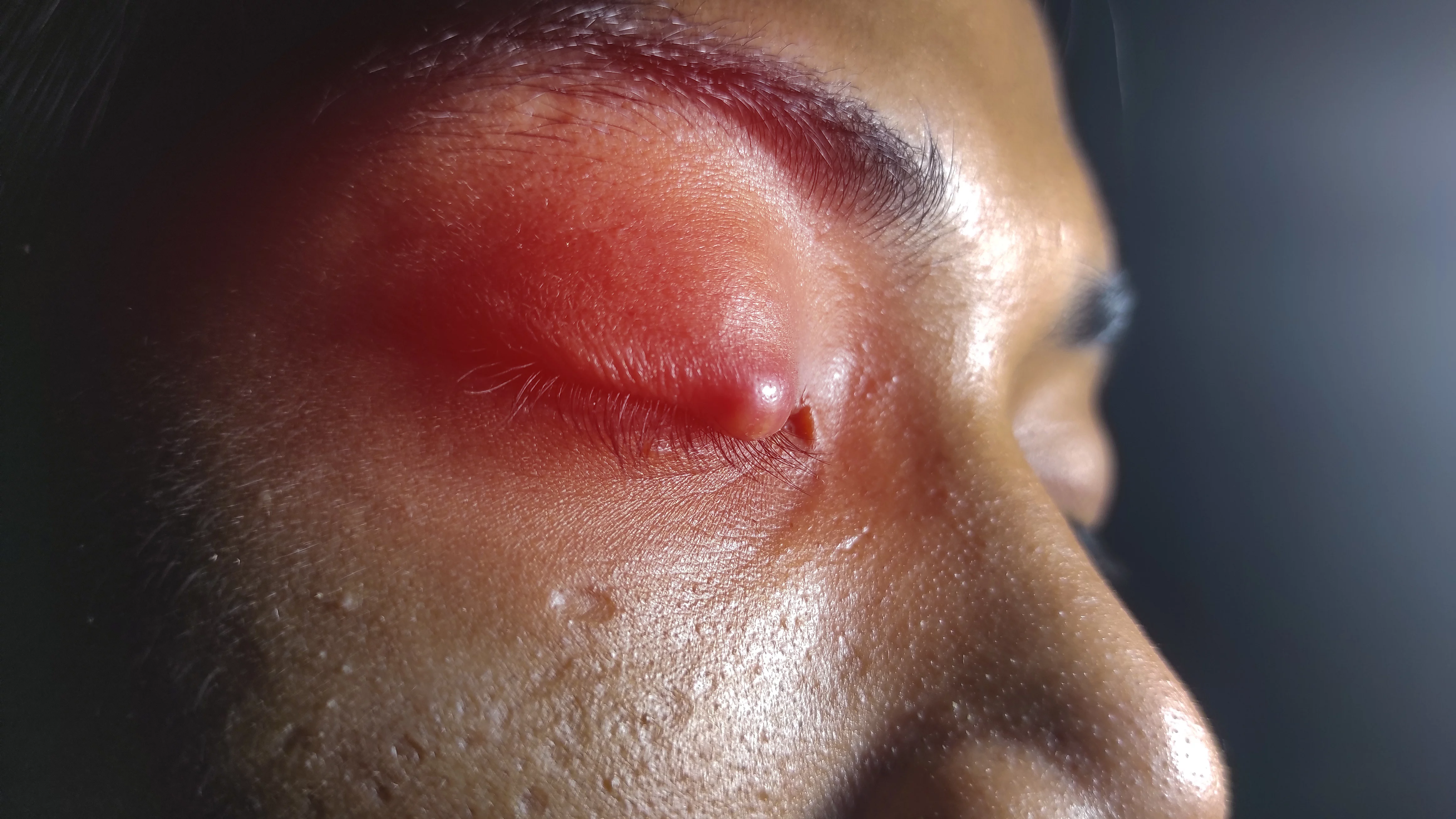 Chalazion