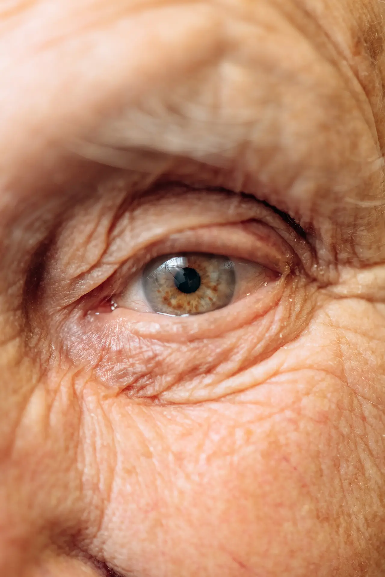 Glaucoma