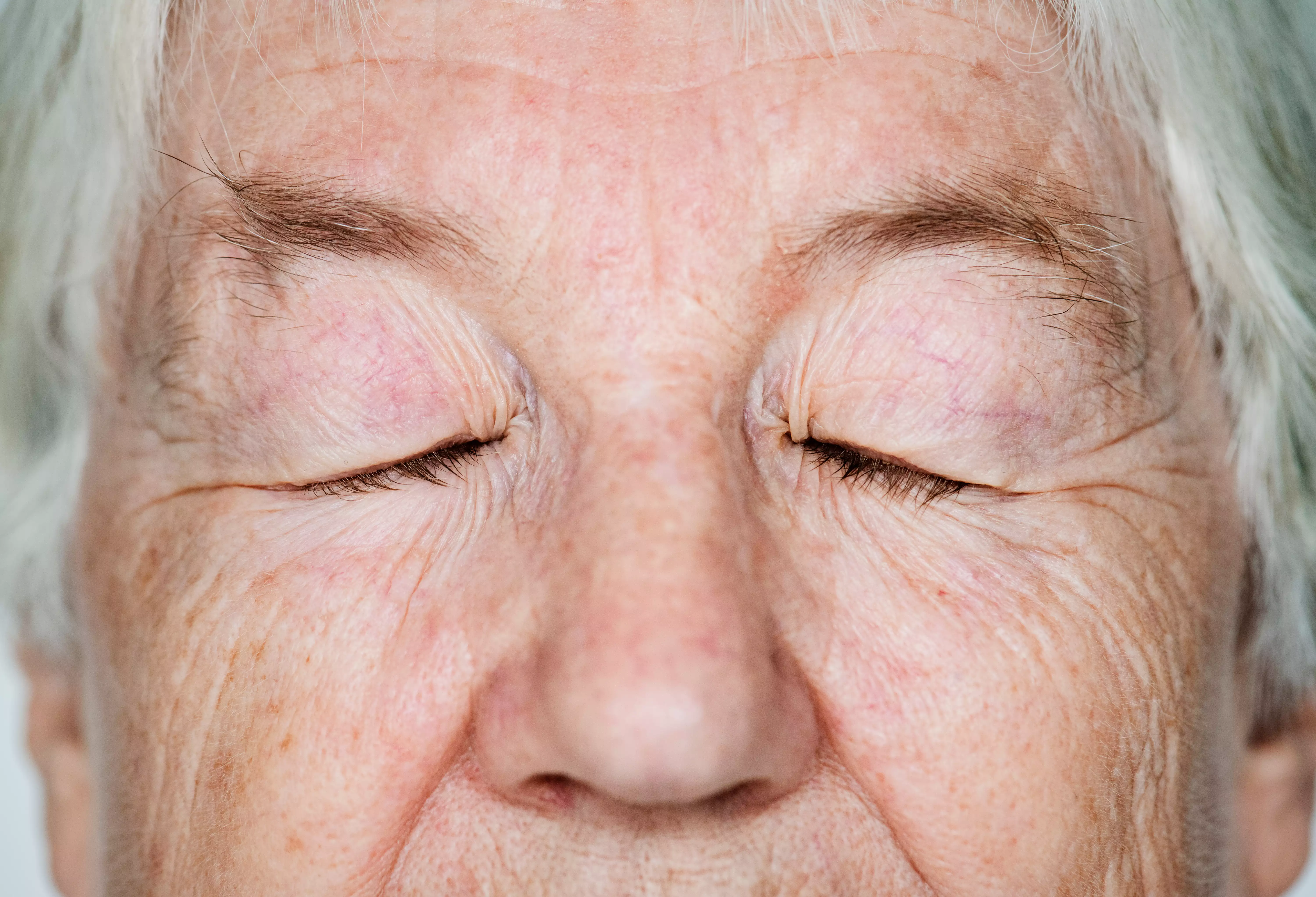 Glaucoma