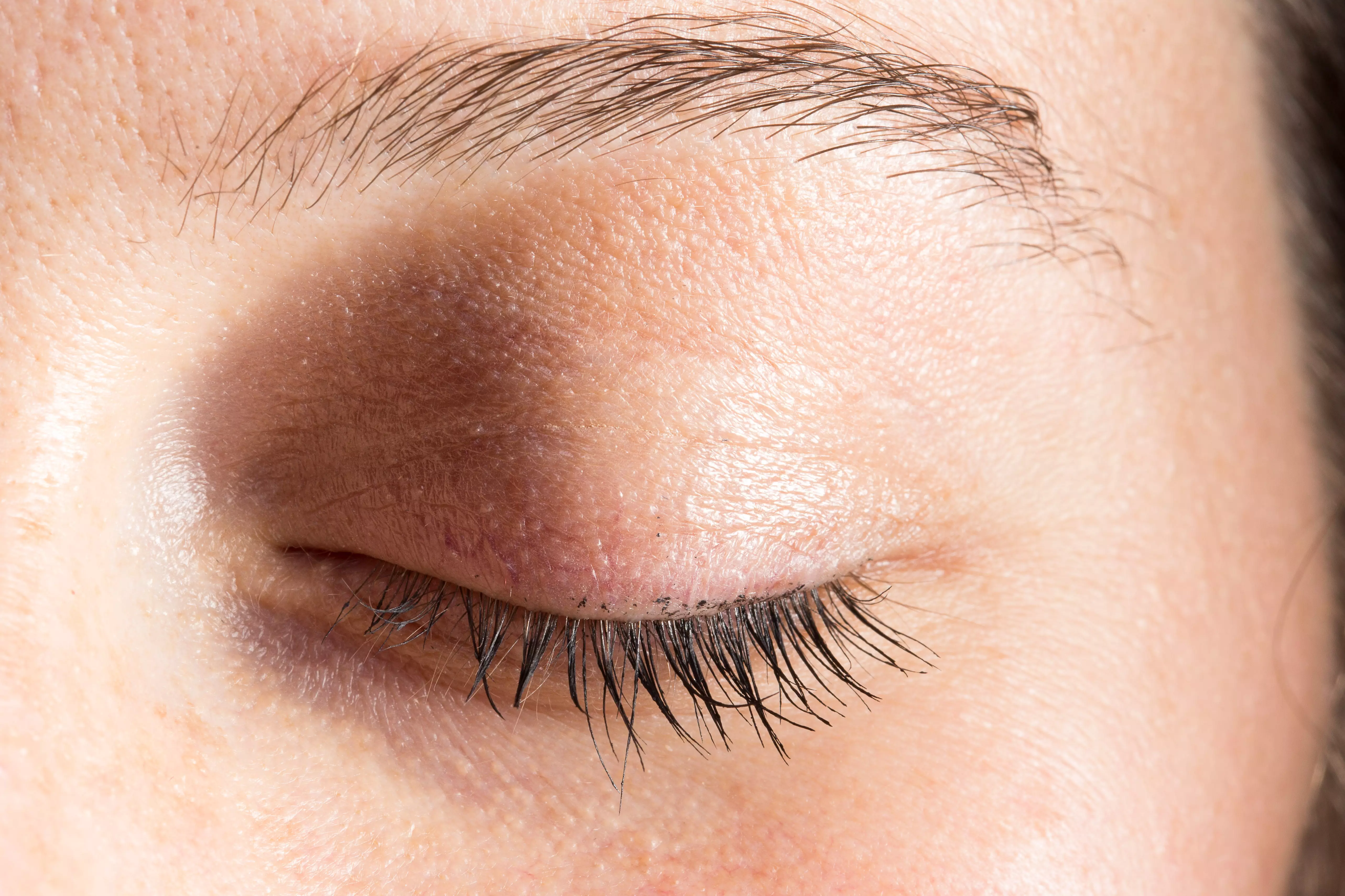 Eyelid hygiene