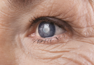 cataract