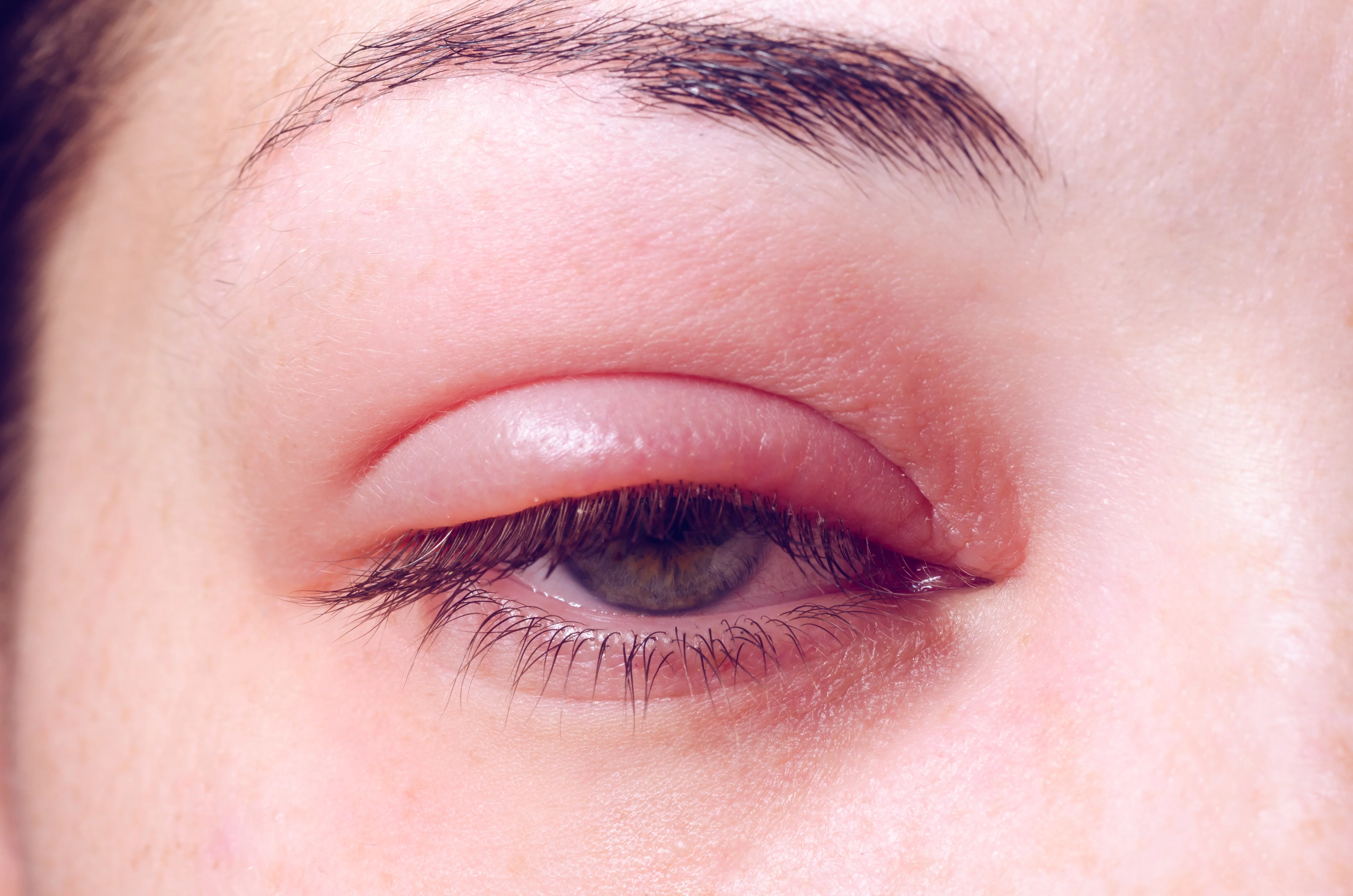 Eye infection