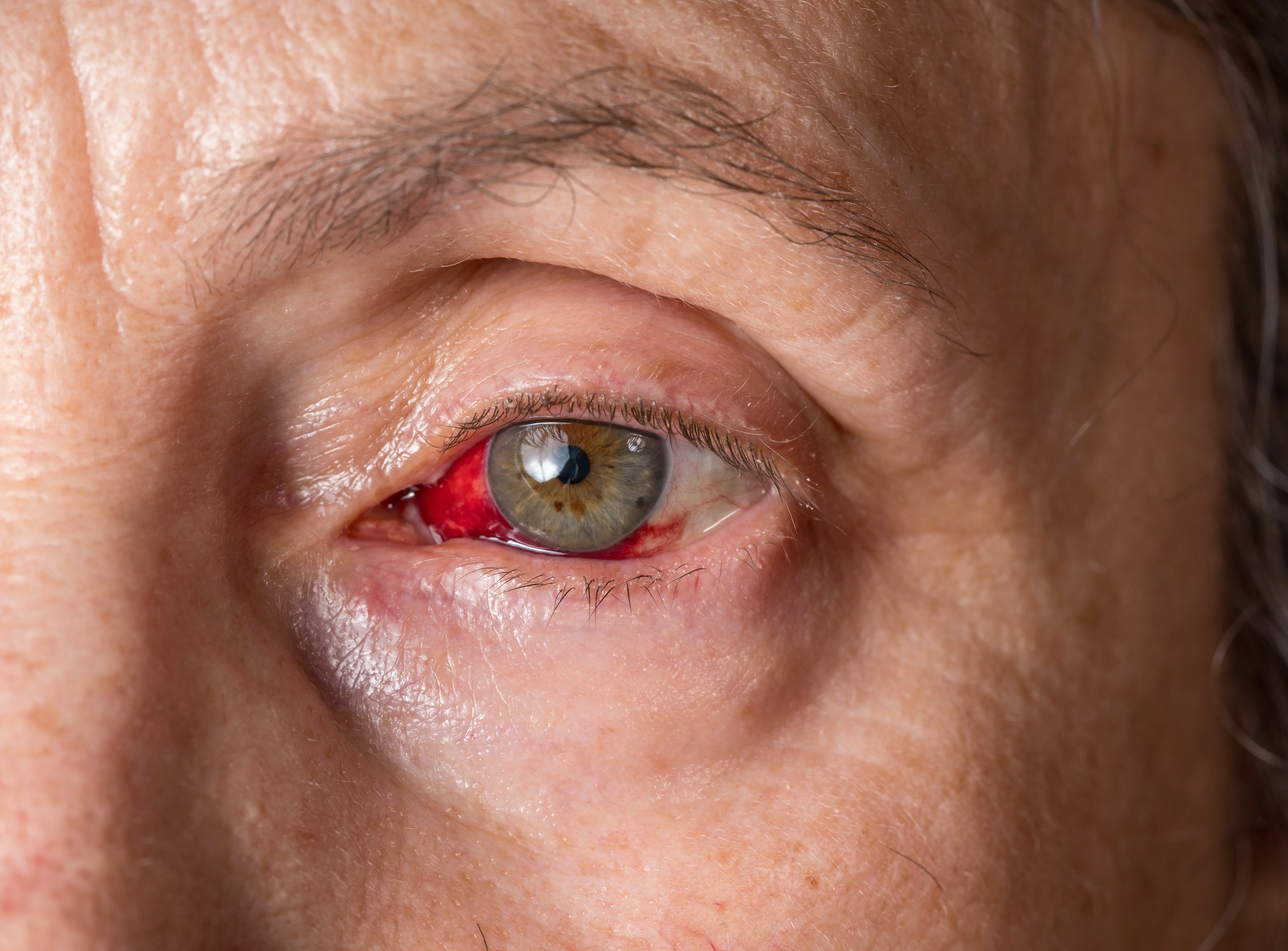 Ocular inflammation