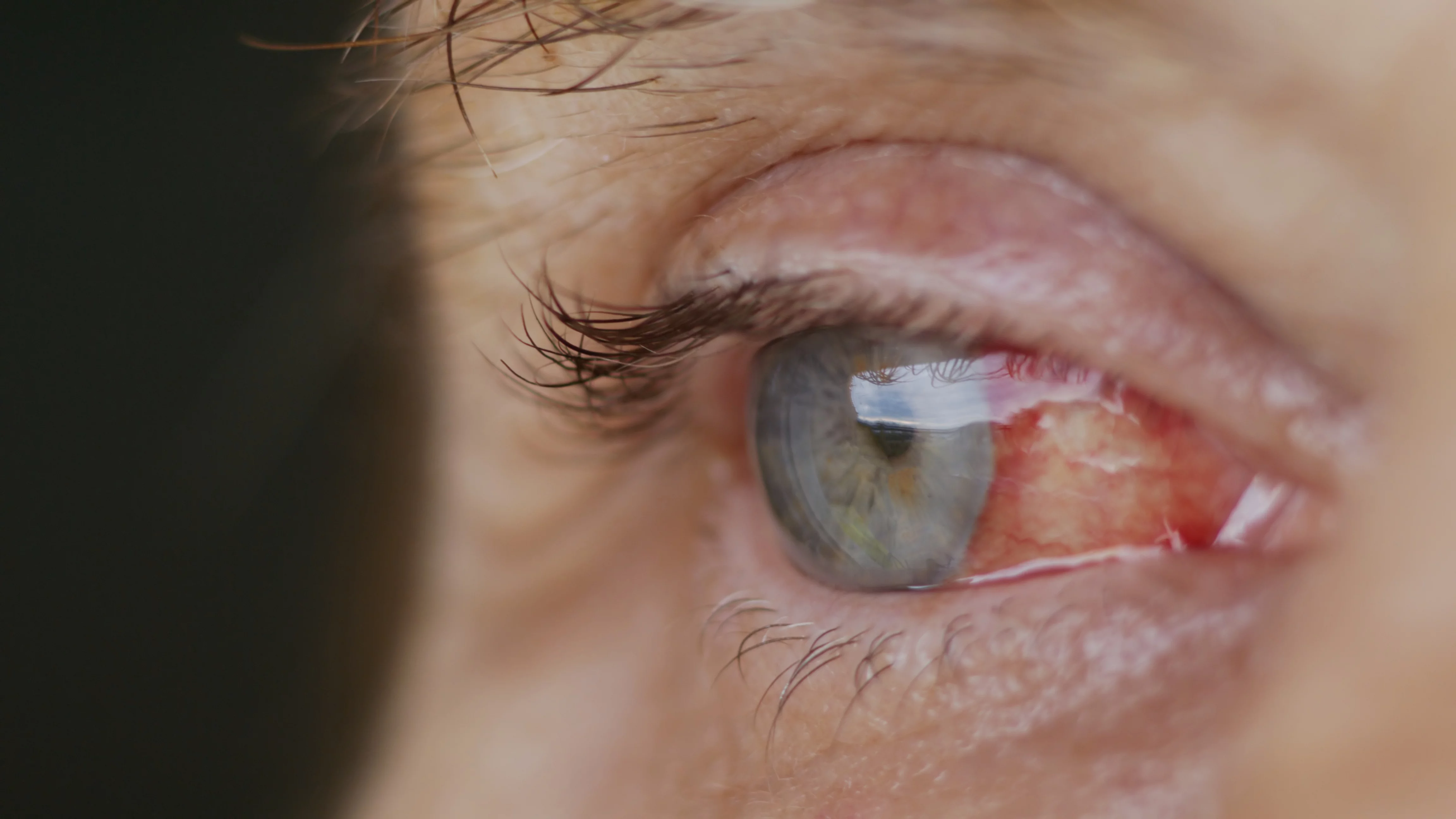 Mydriasis